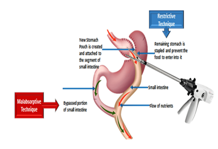 Malabsorptive Treatment | Dr Aloy Mukherjee