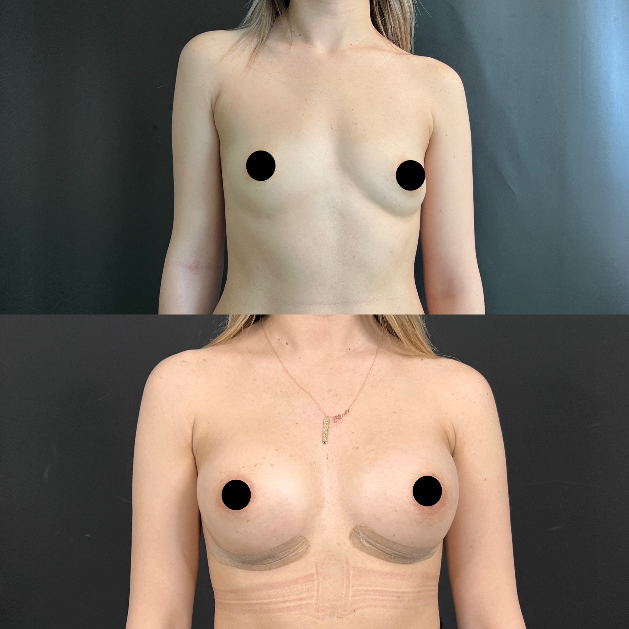 2nd week breast implant before after front view