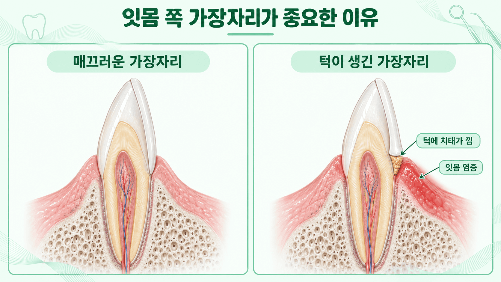 라미네이트 가장자리가 치아와 매끄럽게 이어진 경우와 잇몸 쪽에 턱이 생겨 치태가 끼고 잇몸에 염증이 생긴 경우를 비교한 일러스트