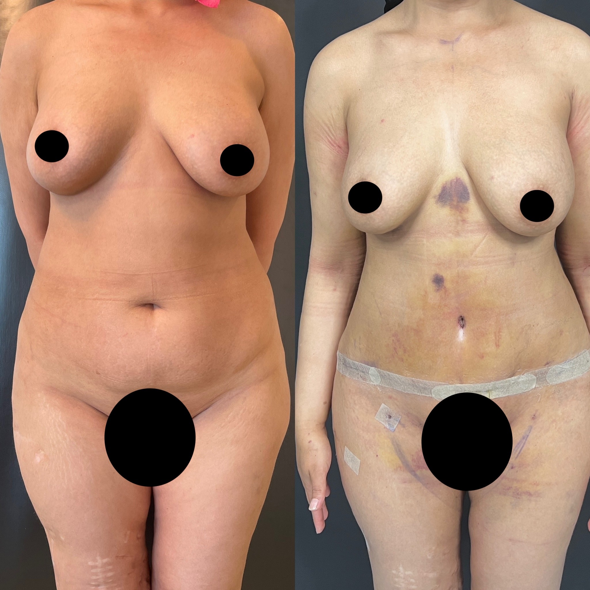 4 days before after photo of tummy tuck and liposuction