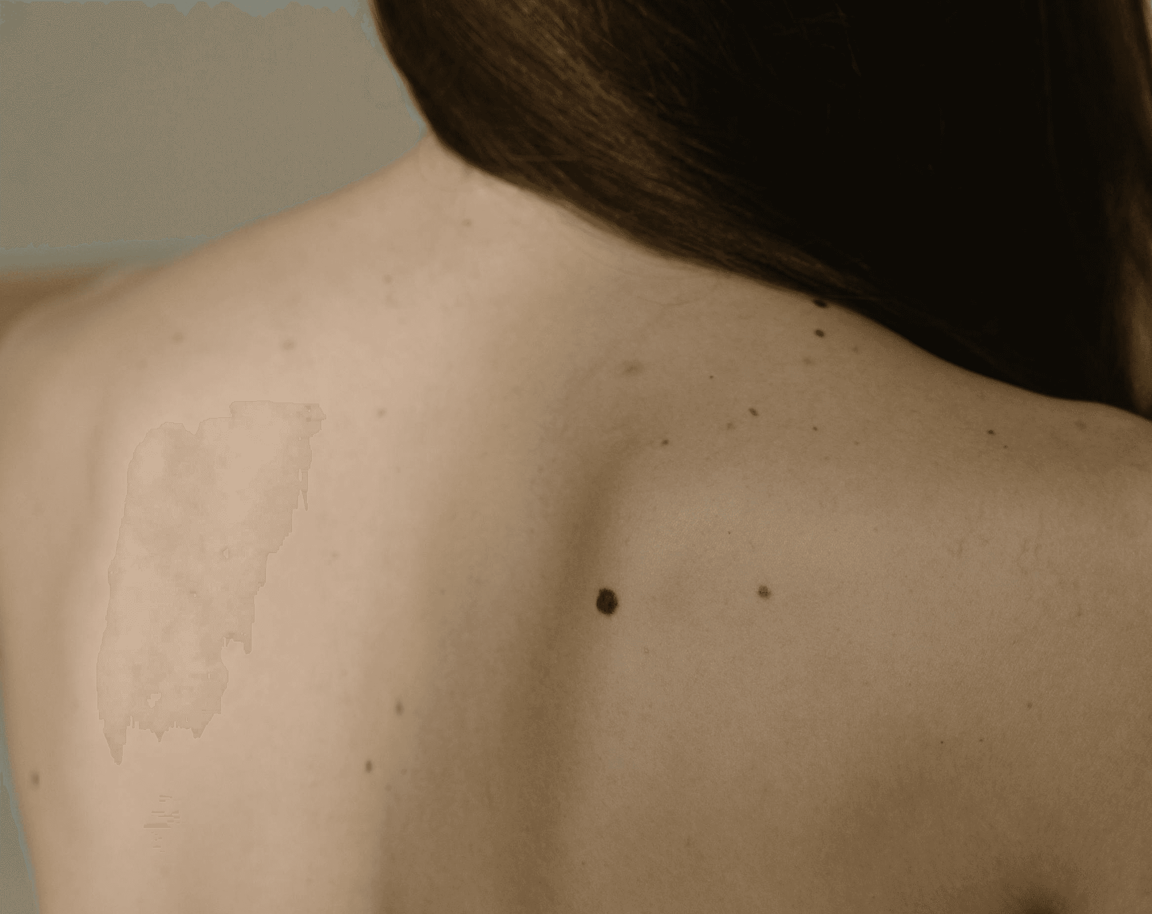 Laser treatment on woman's cheek with protective eye shield