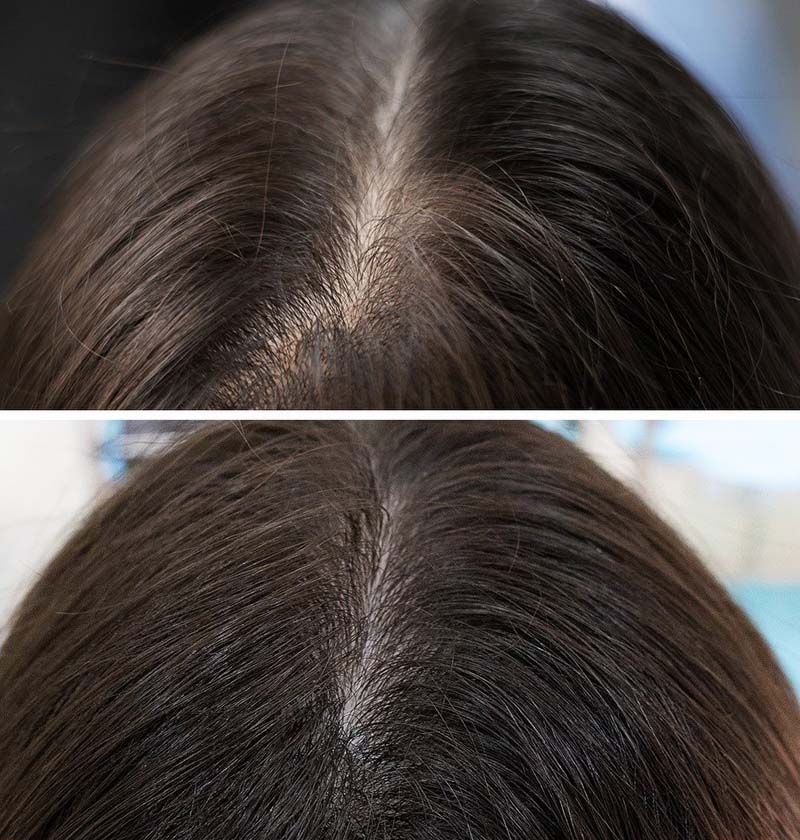 Exploring Reasons: Which Vitamin Deficiency Causes Hair Loss?