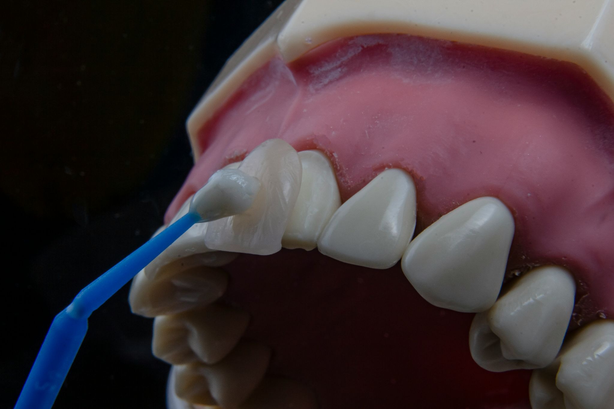 Tooth restoration options