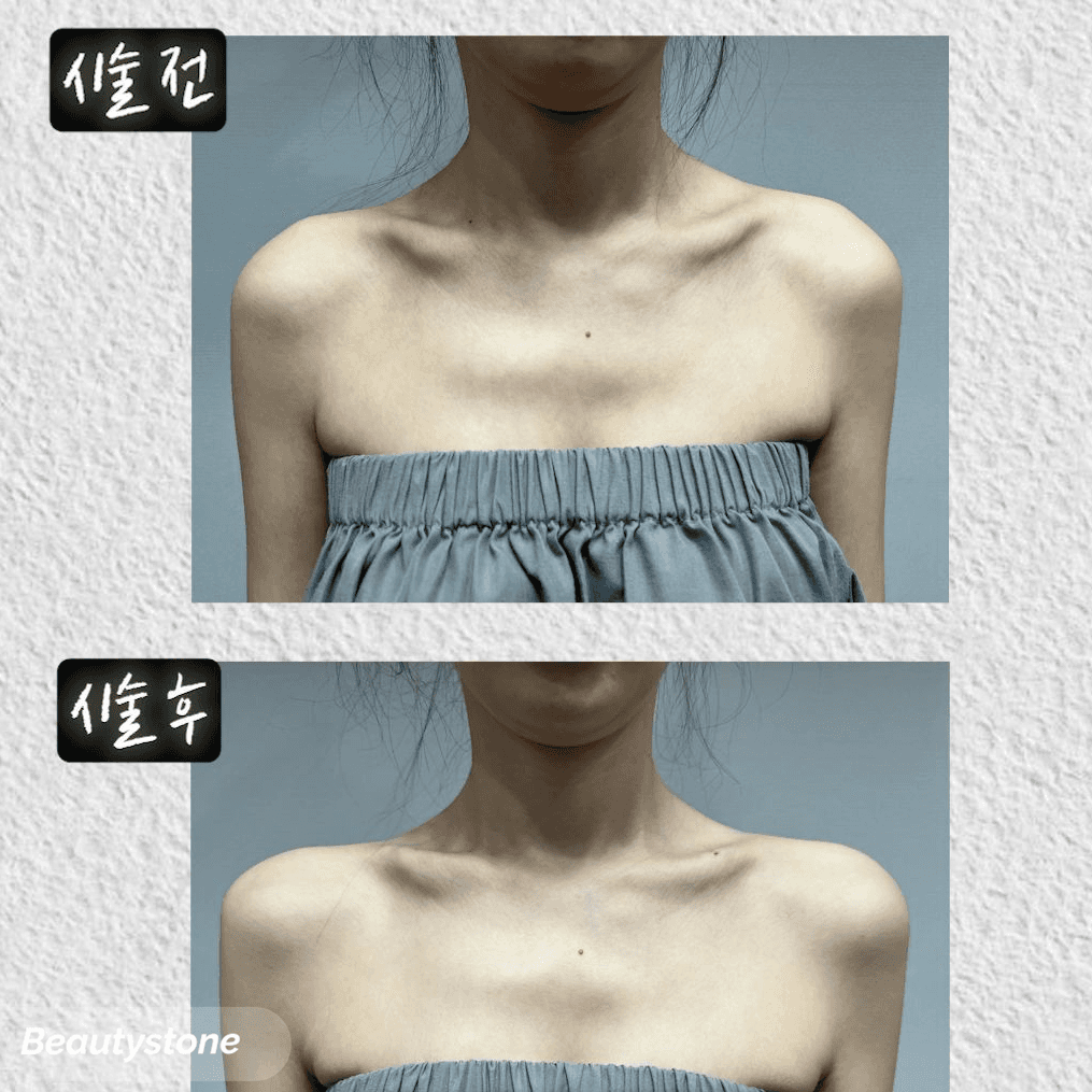 승모근 보톡스만으론 부족할 때, 쥬베룩글램 어깨필러의 시너지