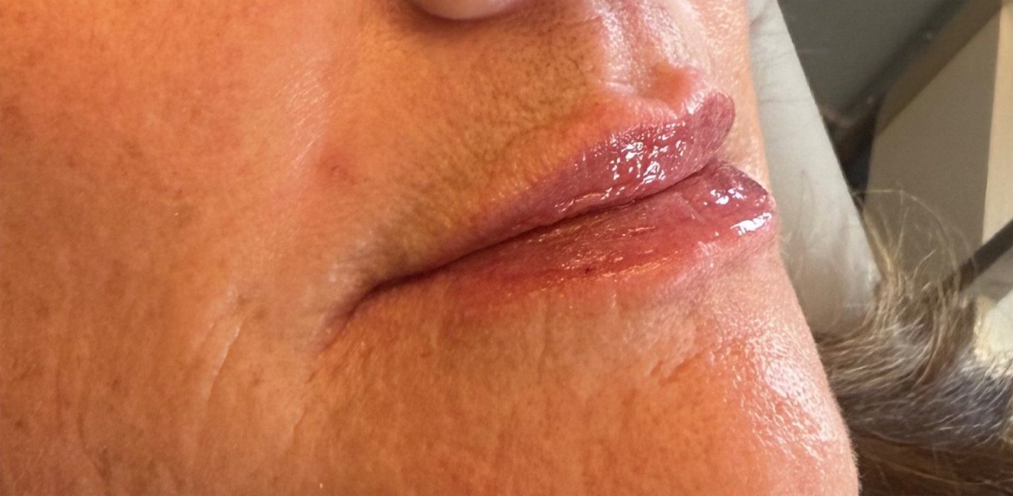 After: close-up of lips.