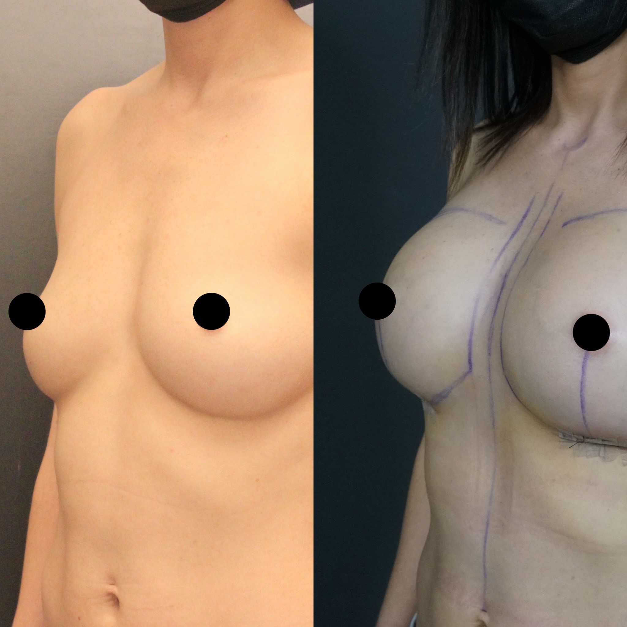 breast implant result 3 days left oblique view