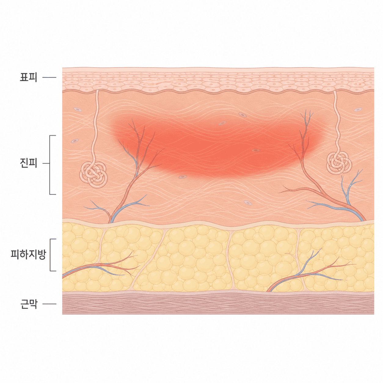 진피 안쪽에 열이 모이는 자리와 그 아래 지방·근막층