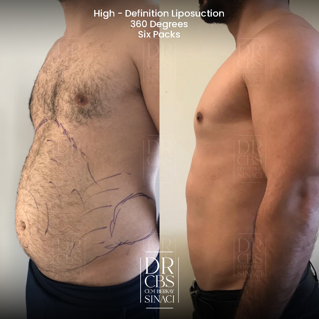 high-def liposuction before after 3 months post-op left side view