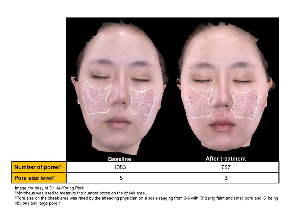 Treatment Protocol on Using Microfocused Ultrasound with Visualization for Skin Quality Improvement: The Korean Experience