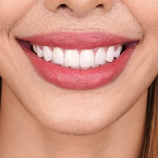 Ceramic Veneer