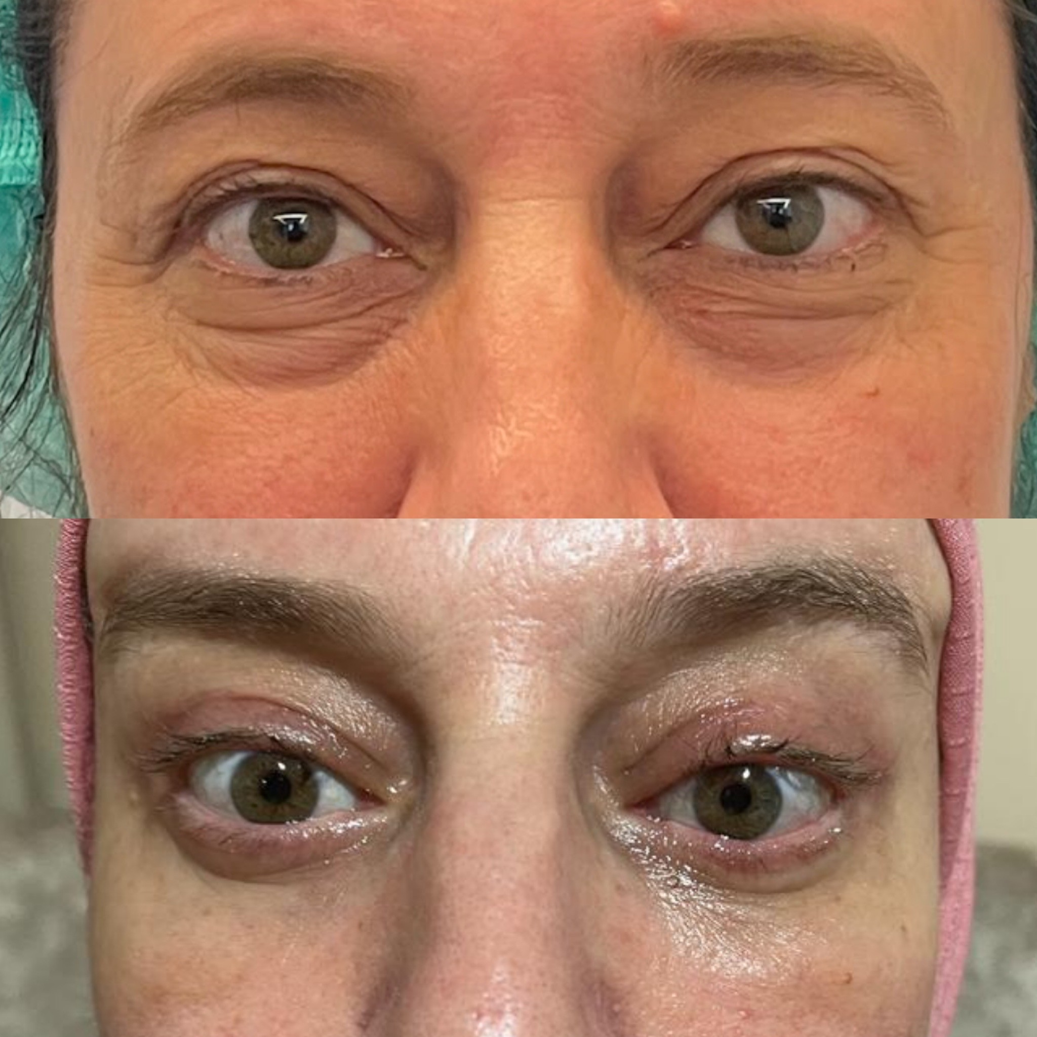 upper and lower blepharoplasty with browlift 3 weeks post-op before and after 