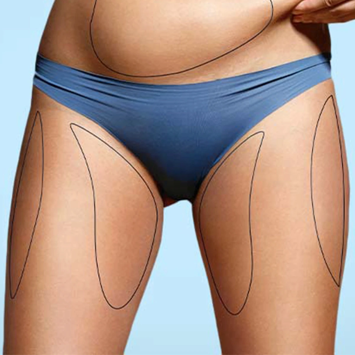 Fettabsaugung am Oberschenkel