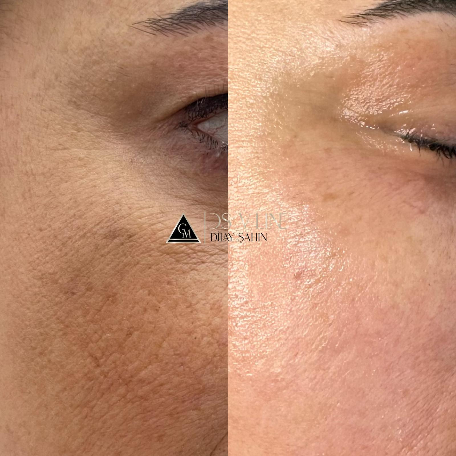 Augenfalten bei einer Frau