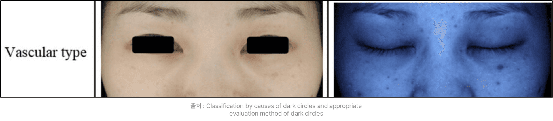 vascular dark circles purple and blue dark circles under eyes
