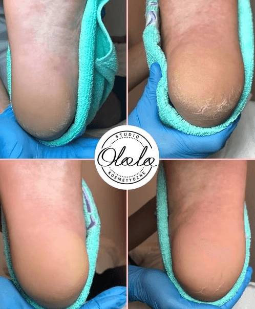 Widoczne rezultaty zabiegu usuwania zrogowaceń na stopach w Studio Olala w Kozienicach.