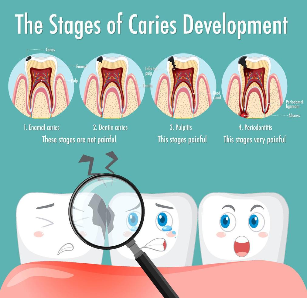 Stages of dental caries image