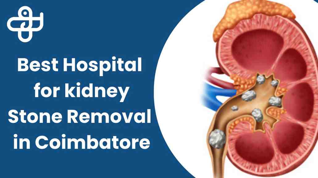 Advanced Kidney Stone