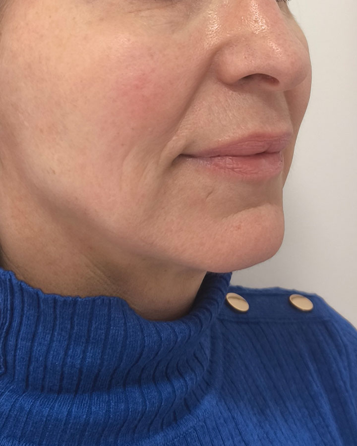 Celková ochabnutosť pokožky tváre pred aplikáciou tkanivového stimulátora Gouri