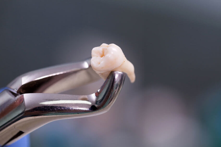 tooth extraction