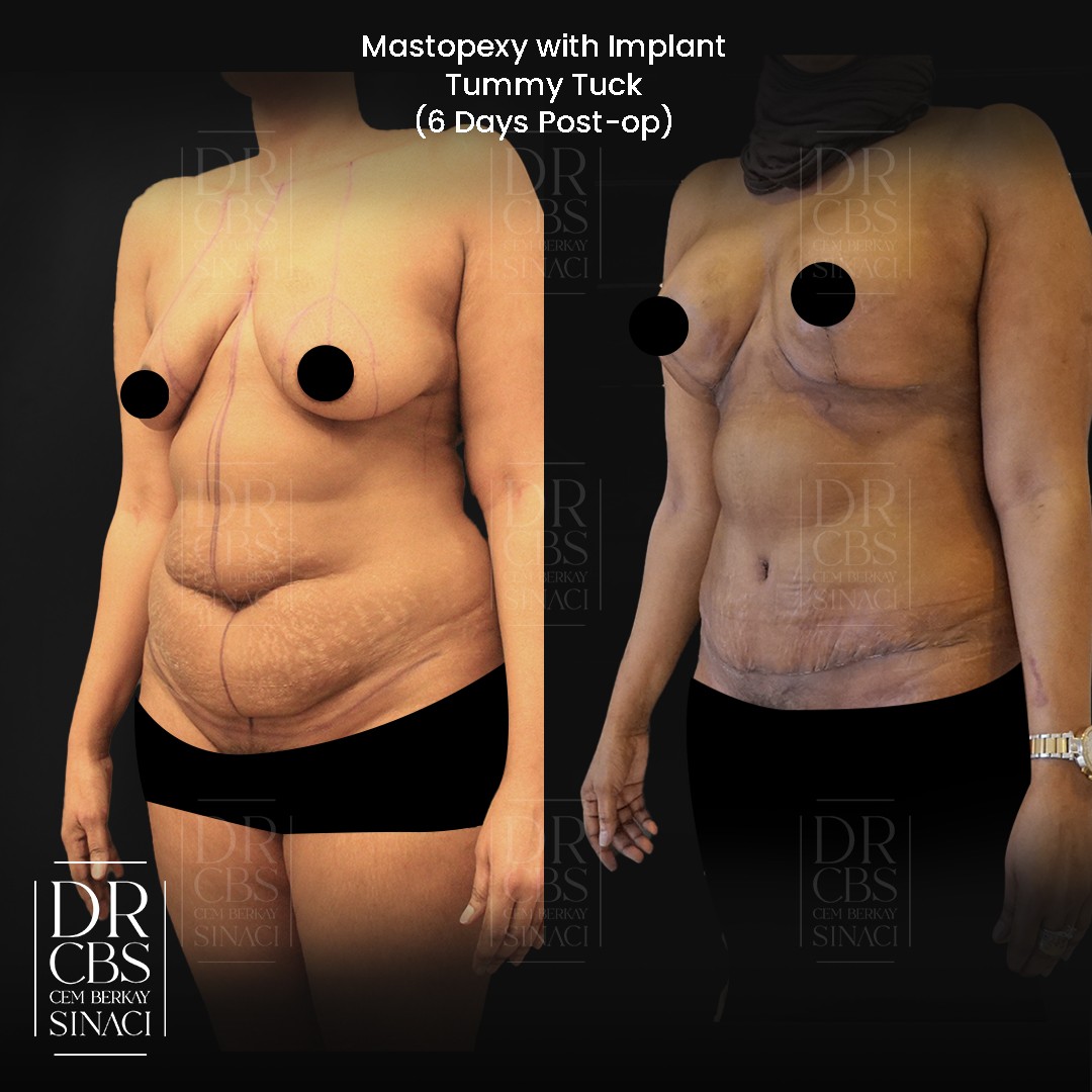 mommy makeover result breast lift with implant and tummy tuck before after oblique view