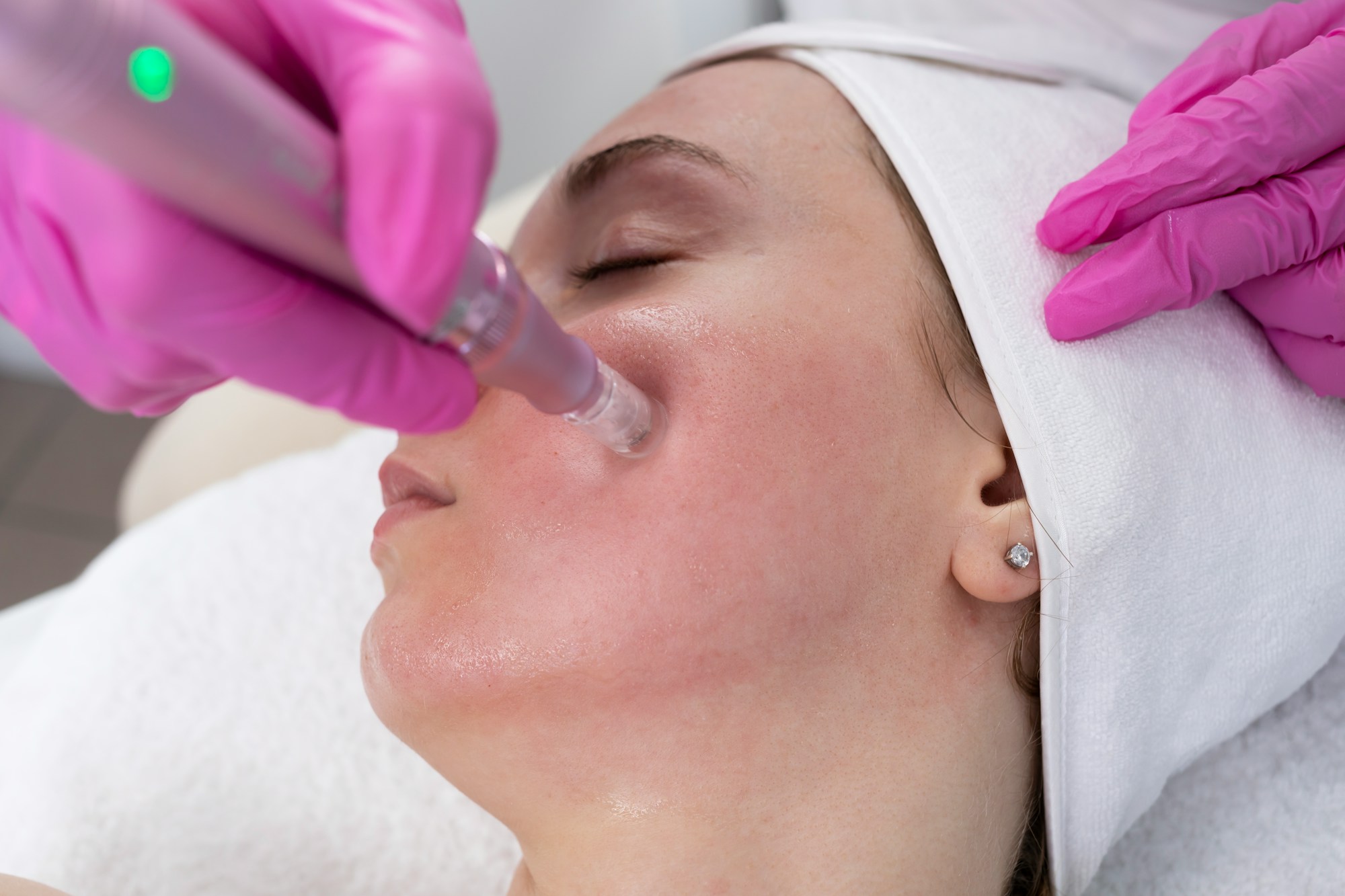 A provider in gloves performing a needle-based skin rejuvenation treatment on a client’s cheek.