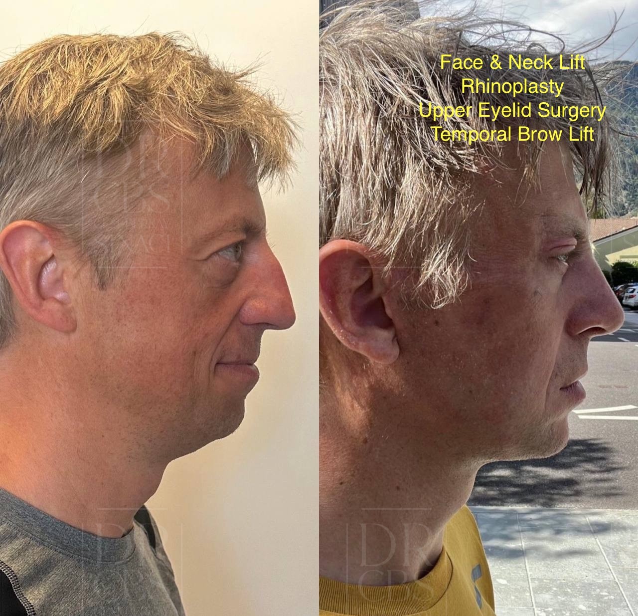 male face lift deep plane, rhinoplasty and browlift 1 month post-op before after