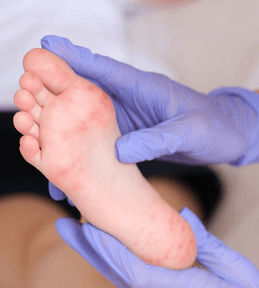 Orvos gumikesztyűben vizsgál egy kiütéses gyermeklábfejet bőrgyógyászati vizsgálat során.