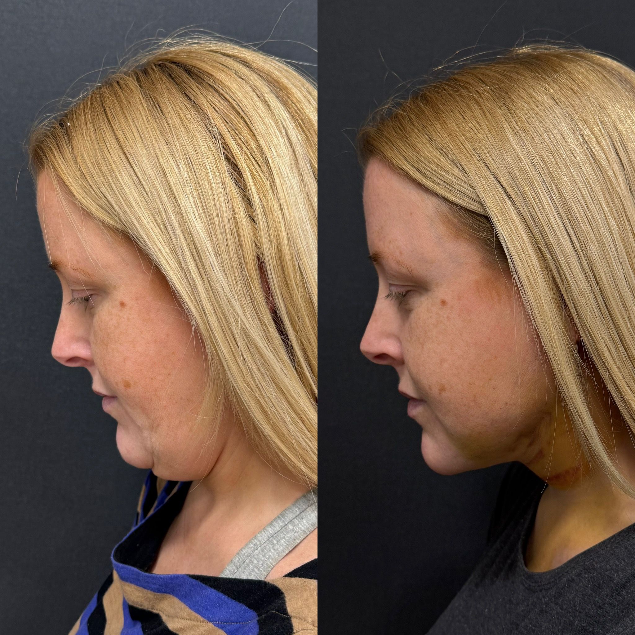 double chin laser liposuction with thread lift 1 day before after side view head down