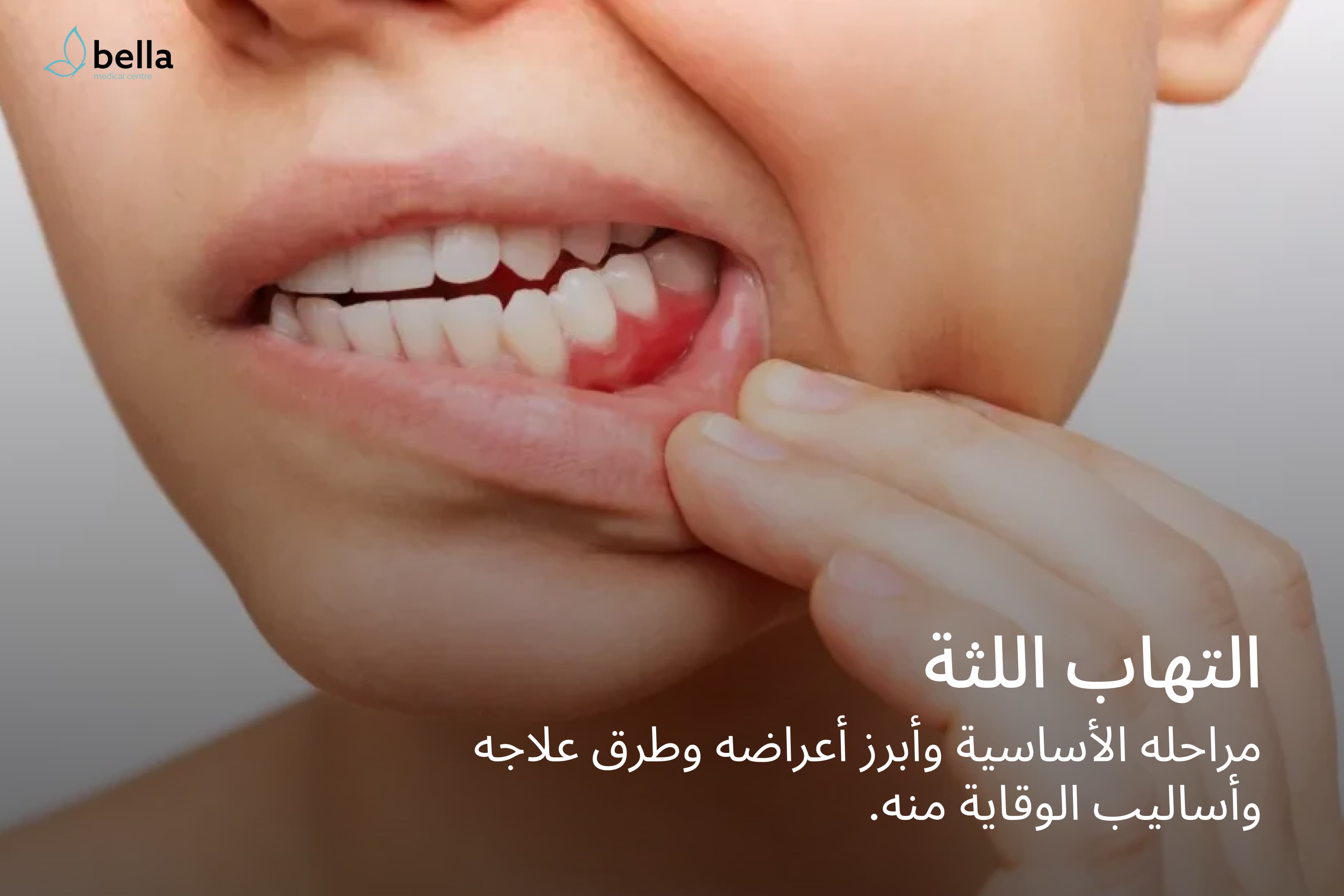 صورة ترويجية حول أمراض دواعم السن، توضح الحاجة إلى علاج لالتهاب اللثة.