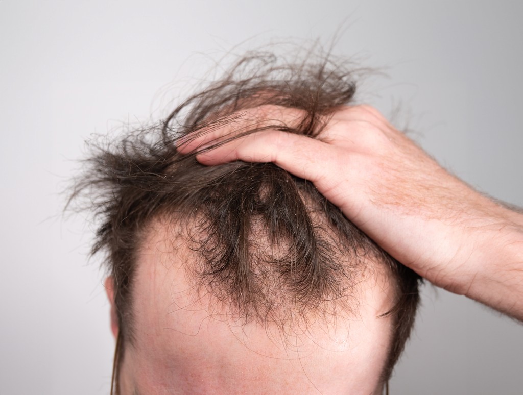 Male Receding Hairline