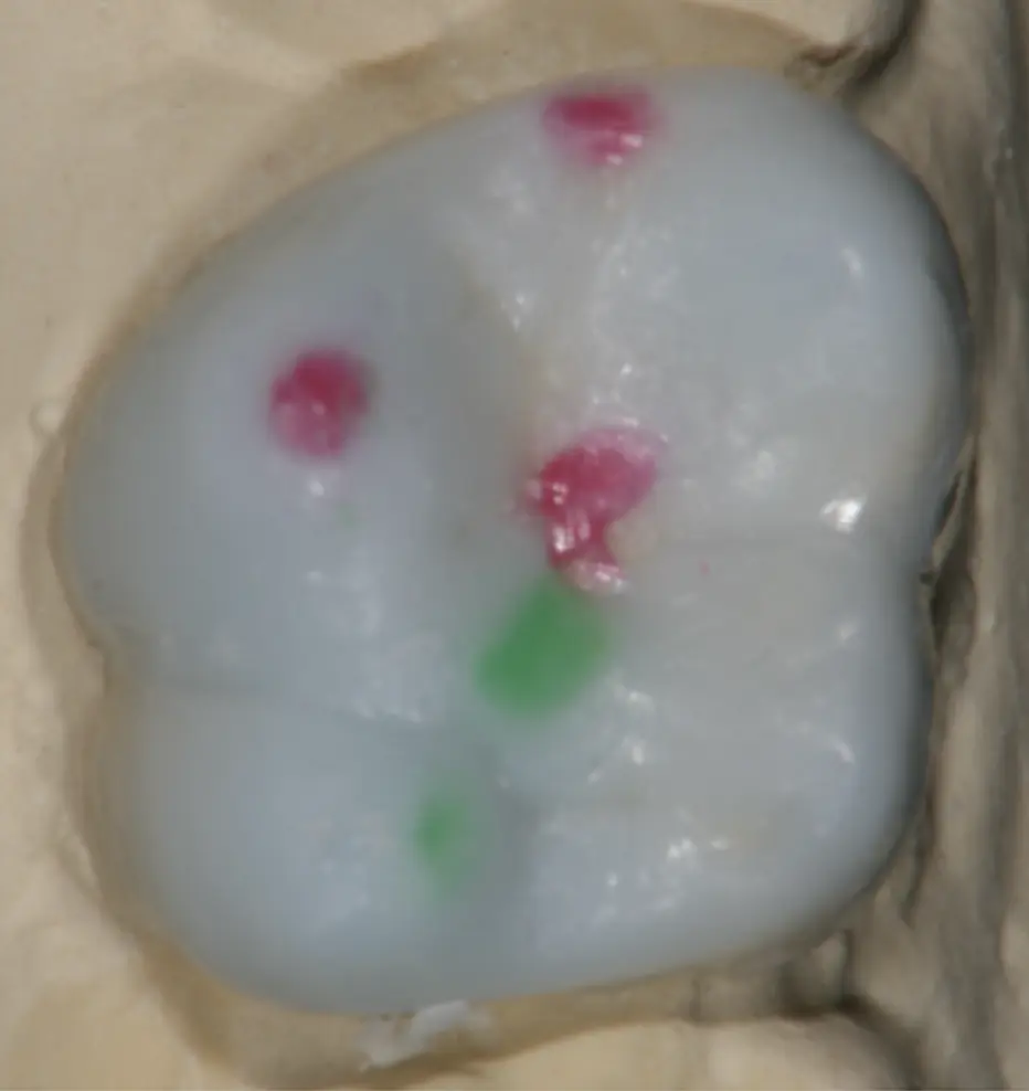 Wax-up-Entwurf der zukünftigen Onlays mit einem speziellen Mechanismus, der den Unterkiefer in eine  grundlegend bessere physiologische Position bringt. Dieser Ansatz entlastet die Kiefergelenke (TMJs)  und fördert ein gesundes Wachstum der Kiefer sowie der Gesichts- und Schädelknochen.