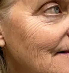 Facial fine lines and wrinkles around eye and cheek.