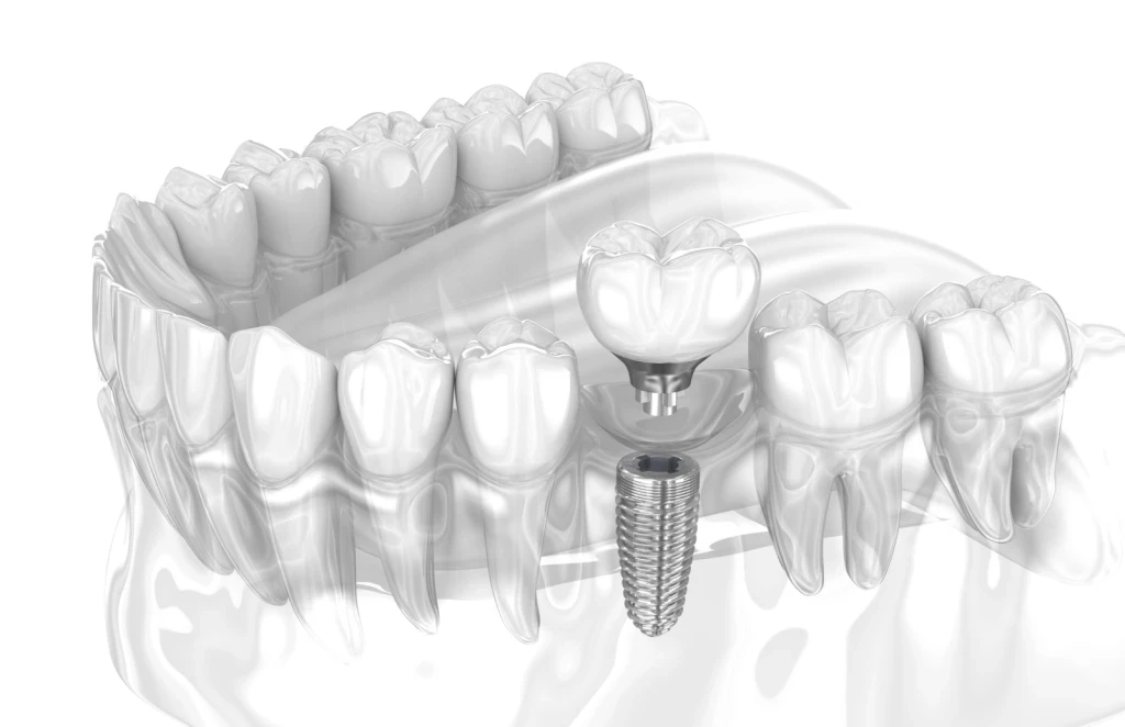 dental implants smyrna