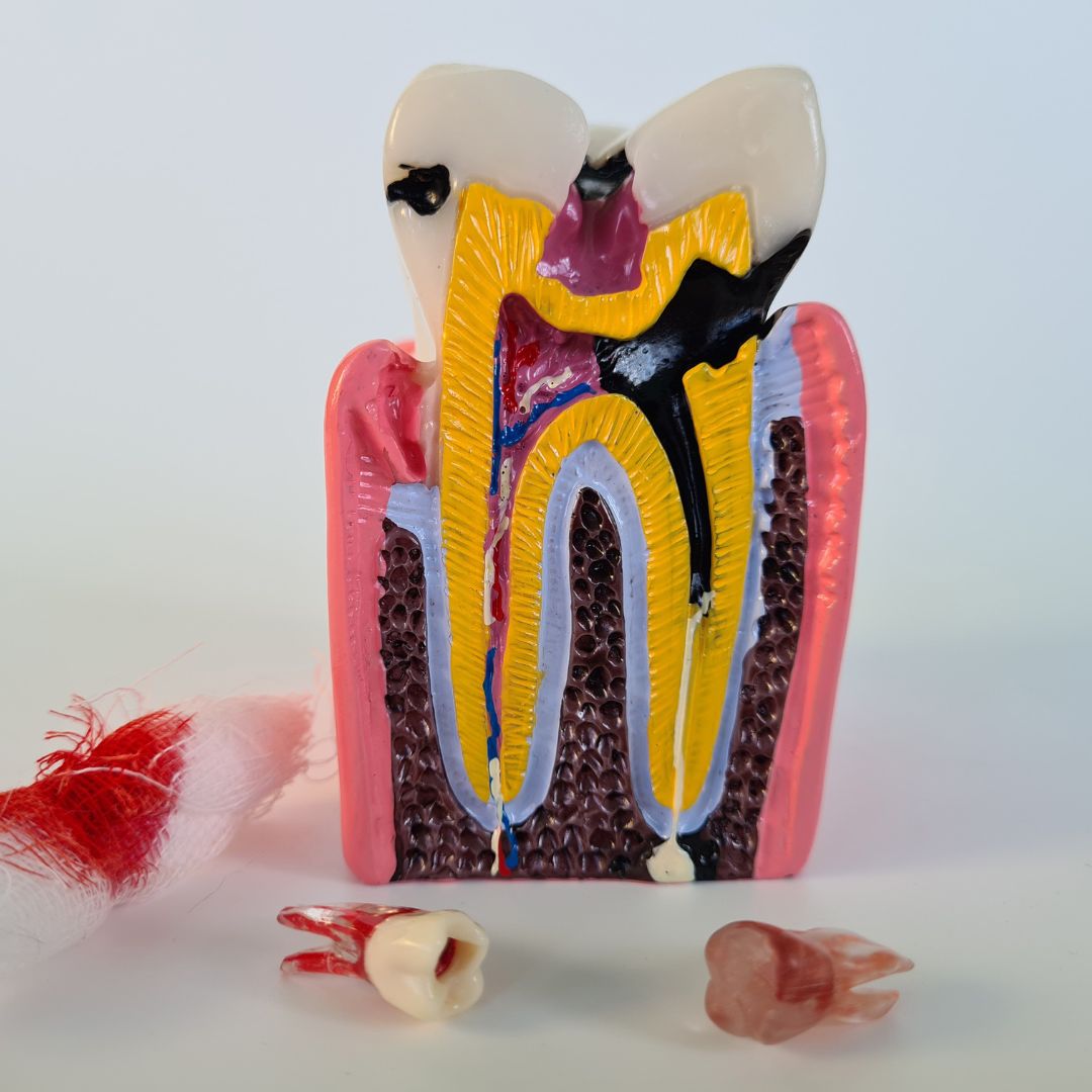 Painless root canal treatment by Dr. Disha Agarwal at Dentistree Kolkata