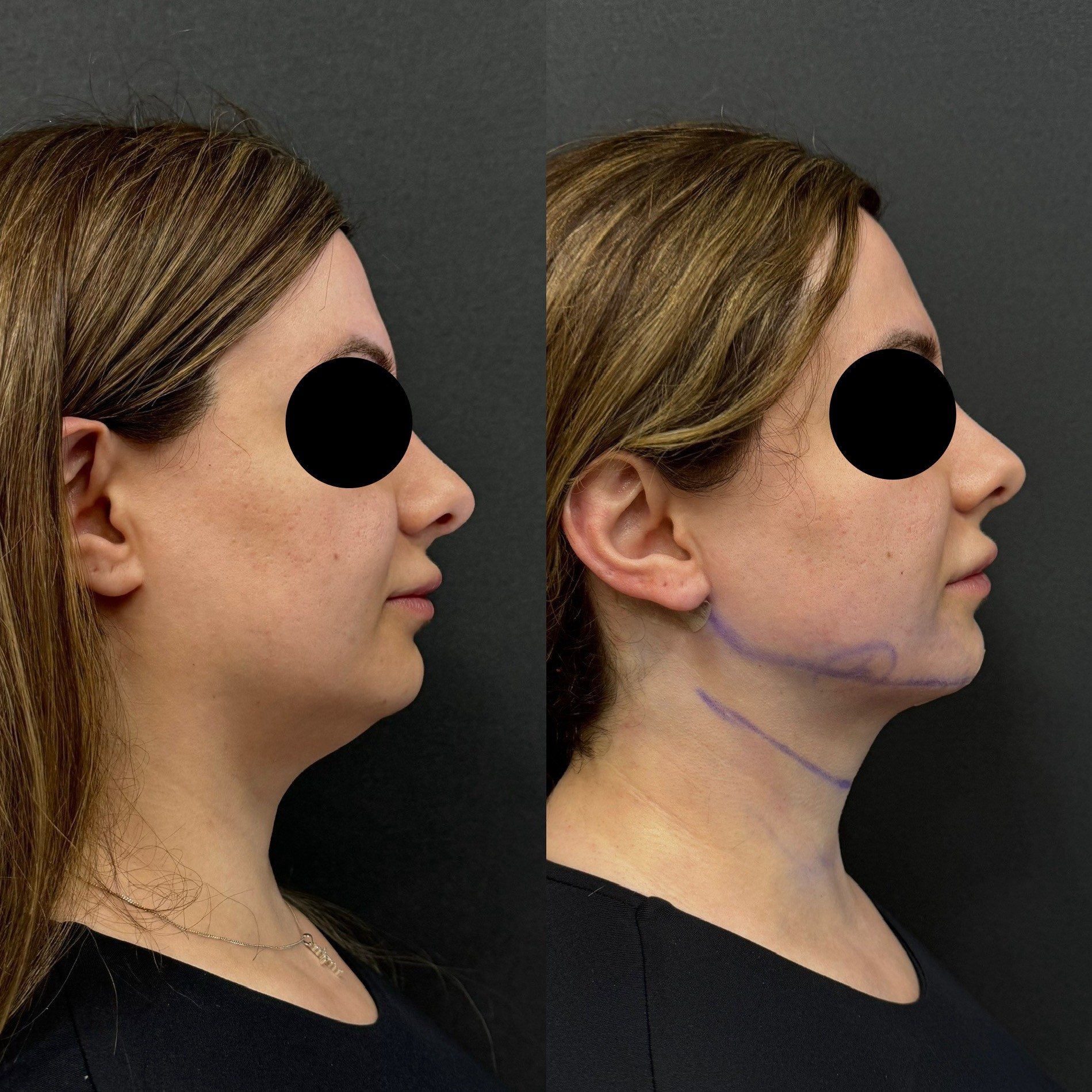 neck laser liposuction immediate post-surgery before after side view