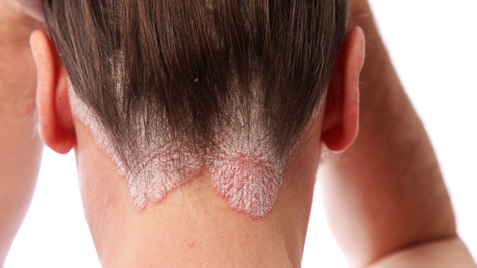 Síntomas psoriasis y prevención