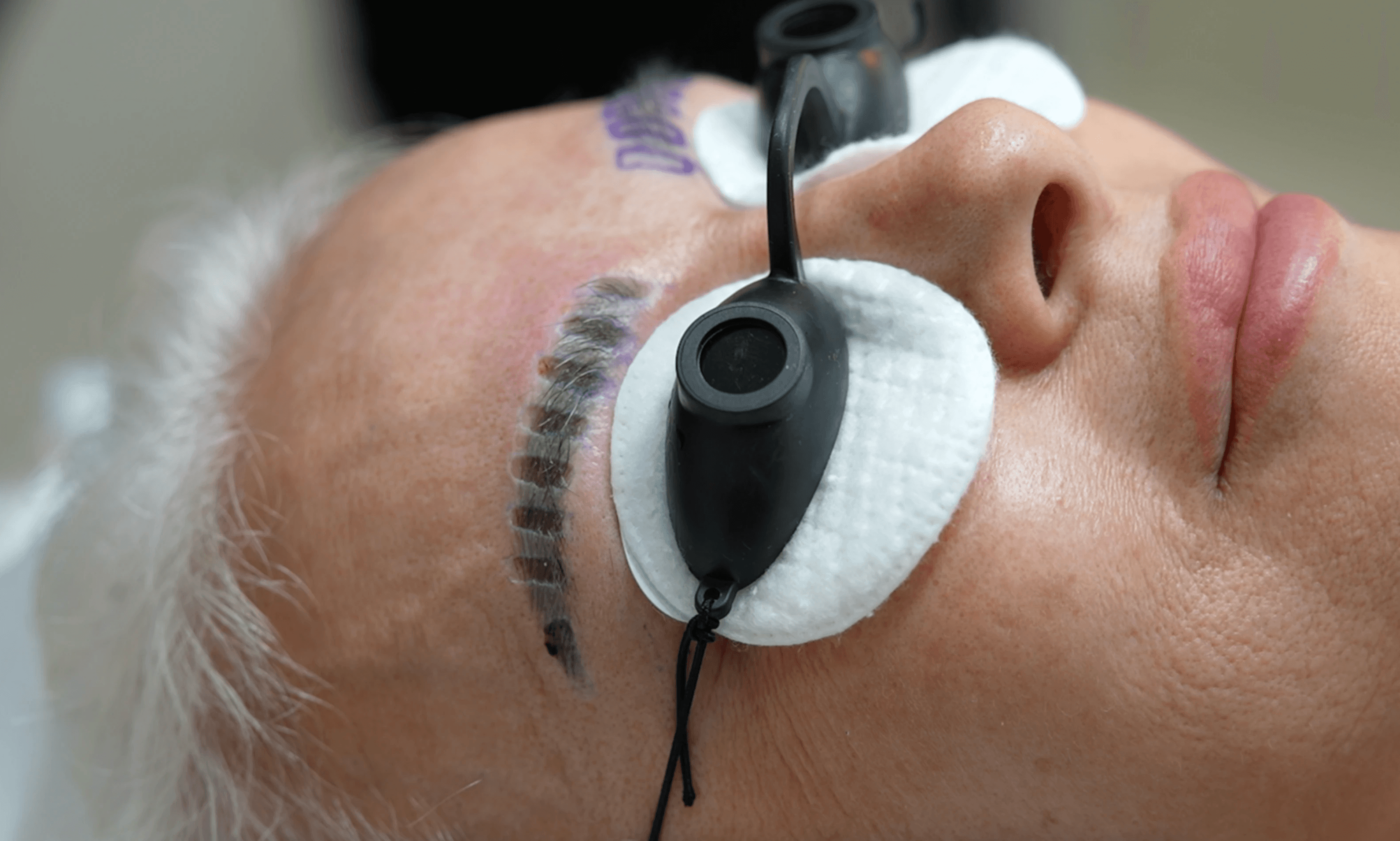 Primer plano del resultado final del primer tratamiento de eliminación de cejas.