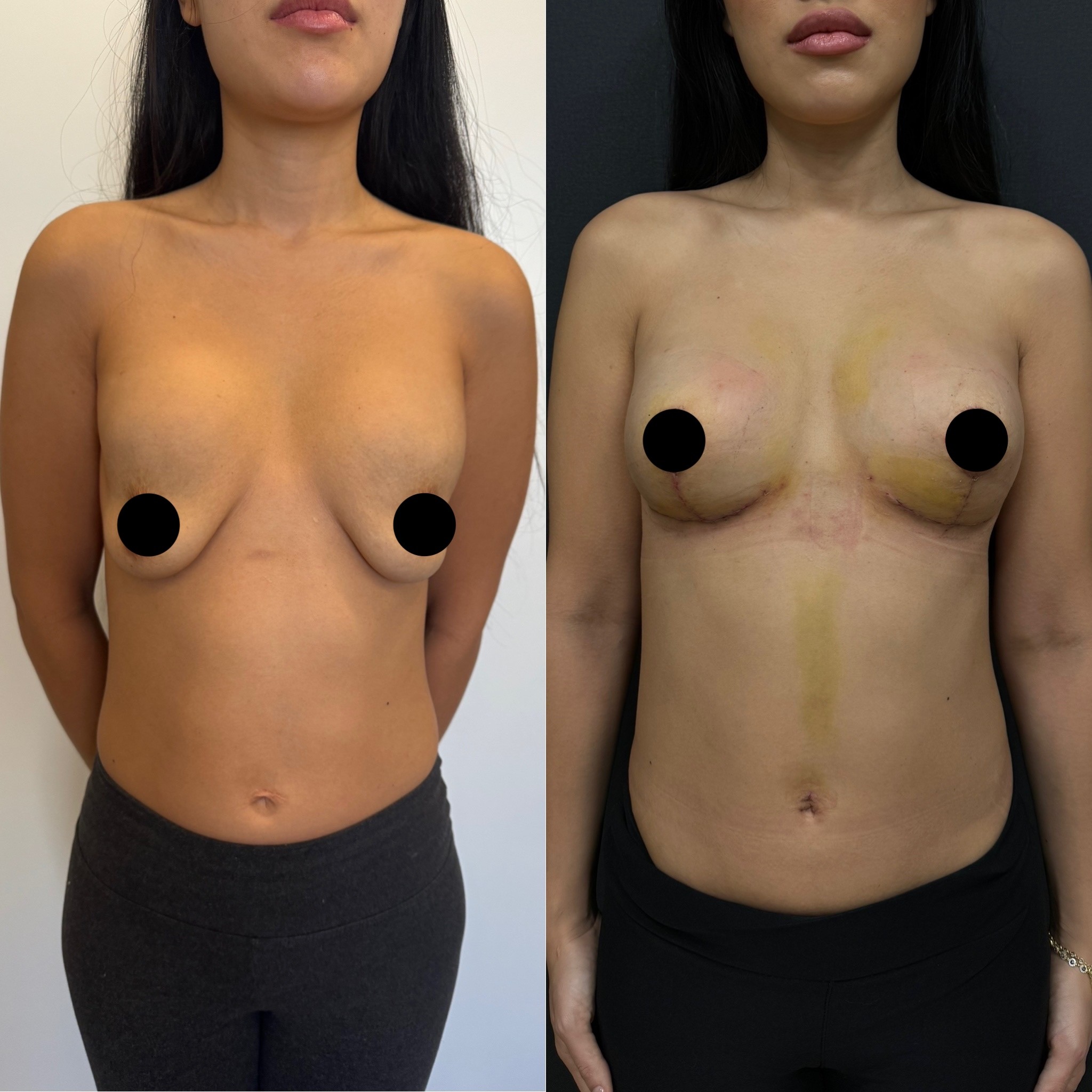 breast implant change and lift before after front view