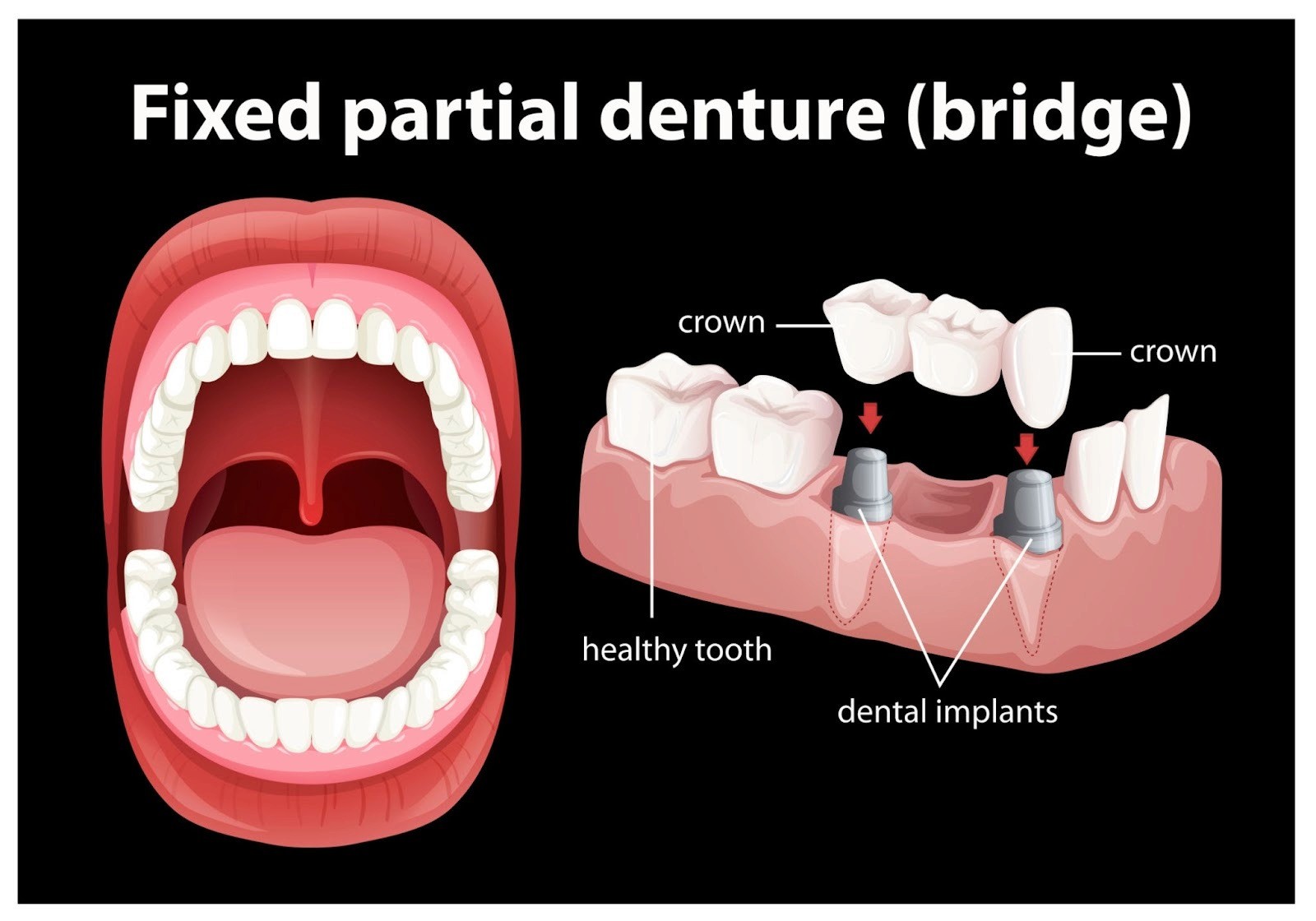 Image of full dentures vs. partial dentures