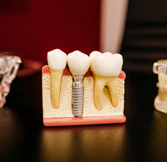 Dental implant and crown models made in the in-house dental lab