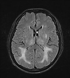 MRI scan of a brain showing no signs of tumor.