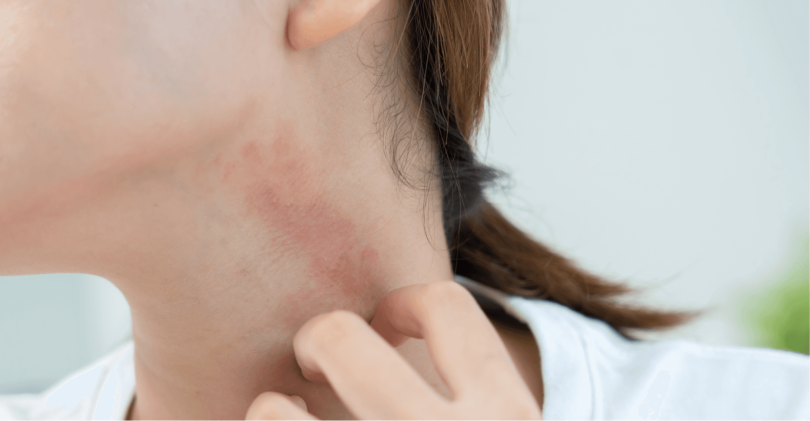 woman with eczema on neck
