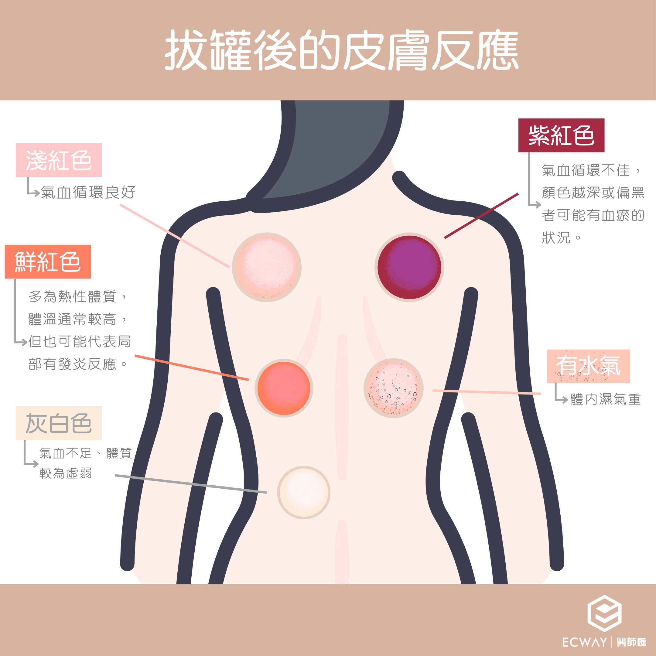 拔罐後的皮膚反應