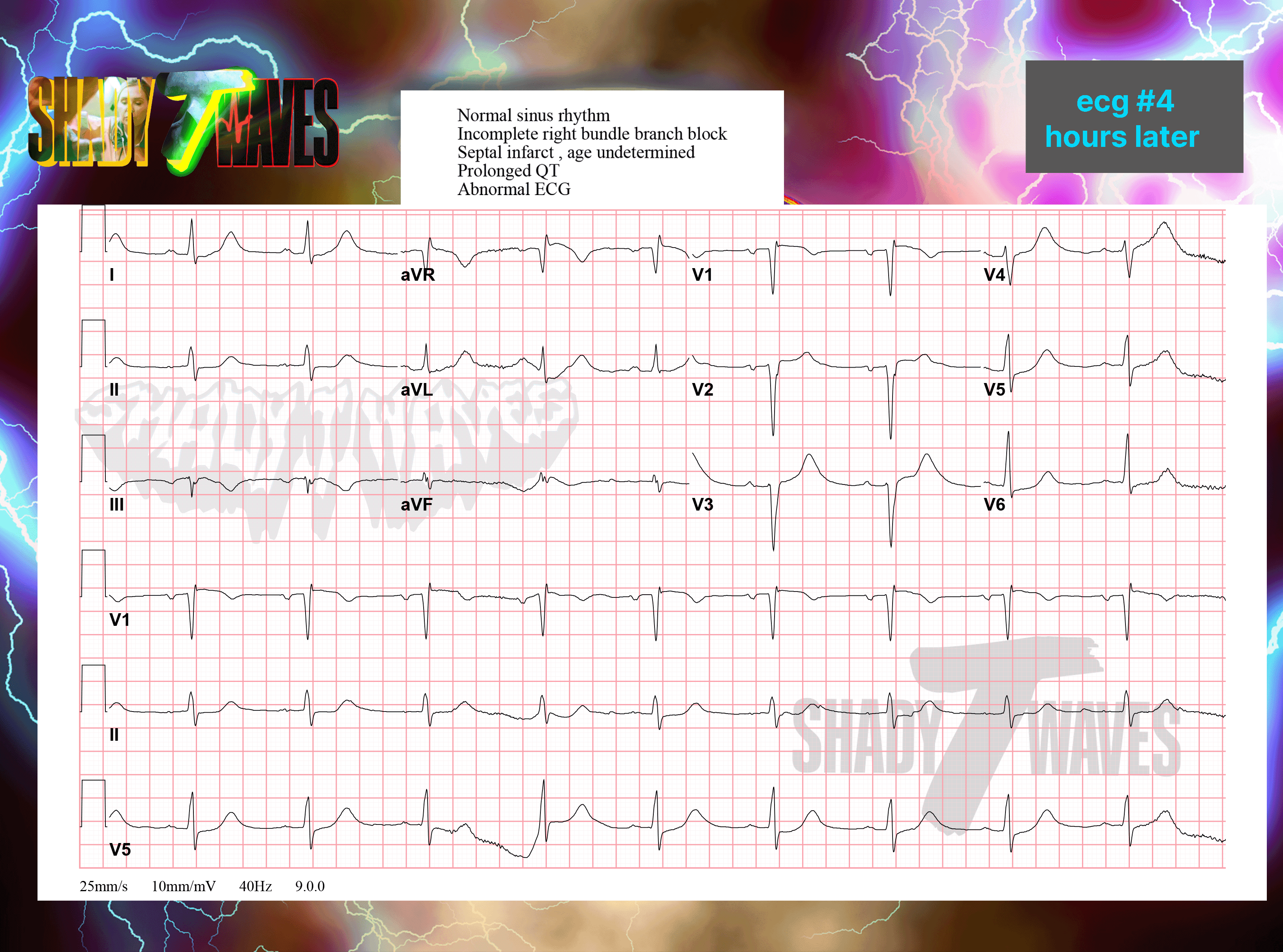 ECG #4