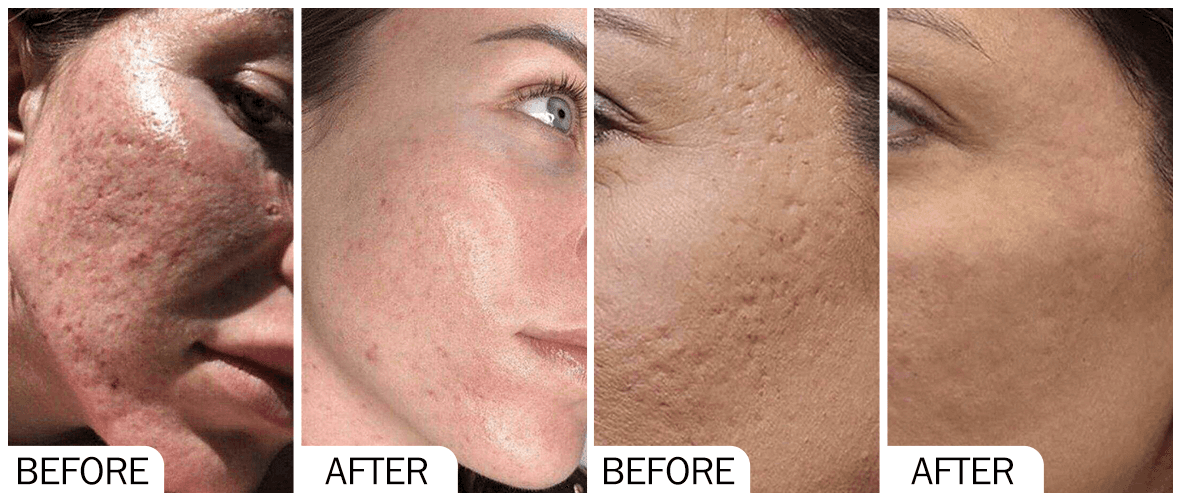 PDRN for Skin: The Complete Guide to Benefits, Results, and Treatments