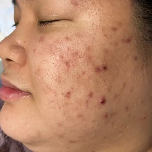Before acne scar and pigmentation treatment at The Vancouver Aesthetician — mild pitted acne scars with hyperpigmentation and dark marks on skin