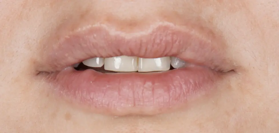 After ortho treatment