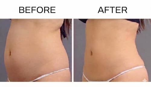 EMSによるお腹のbeforeとafter。ぽっこり出ていた下腹部がすっきり平らになり、ウエストが引き締まった変化