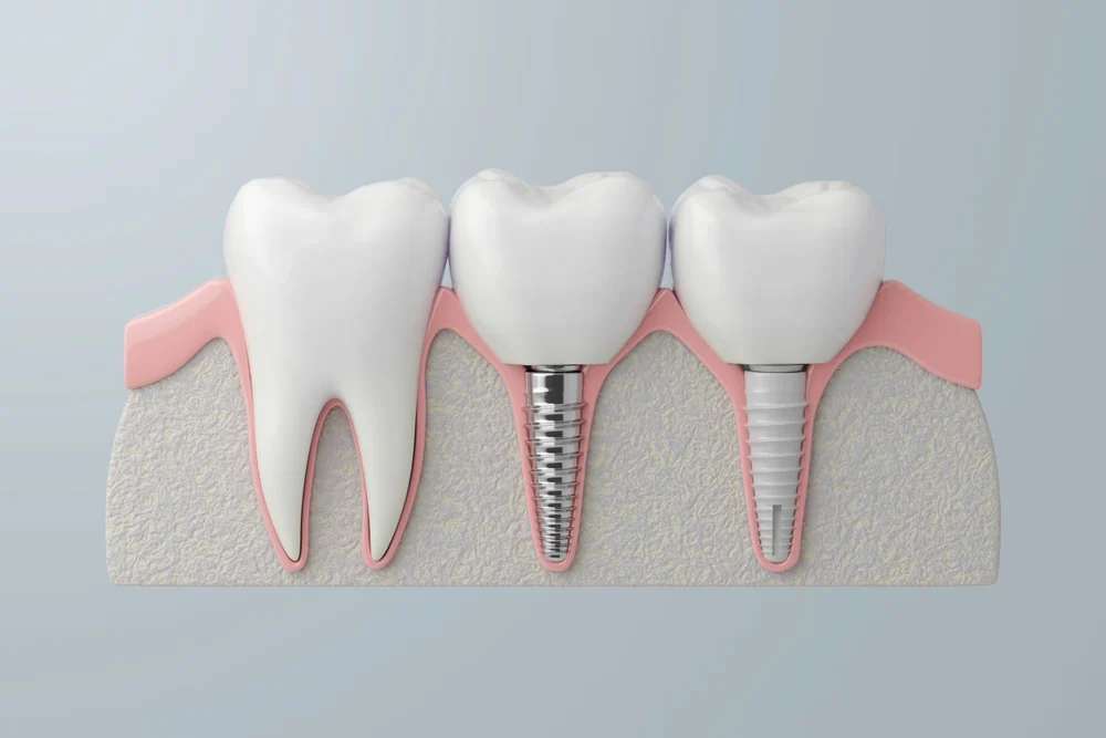 smyrna dental implants