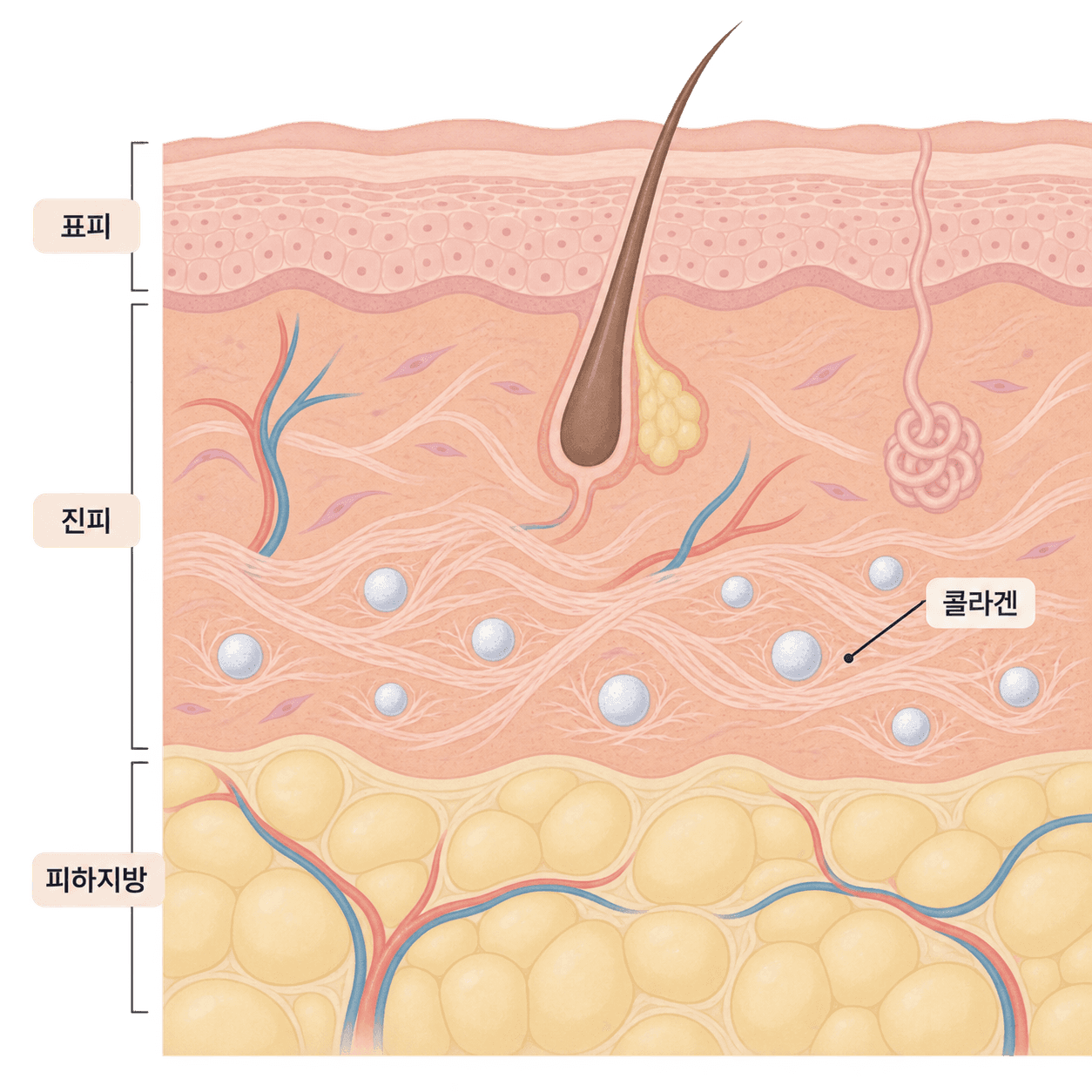 진피 깊은 층과 피하지방 사이에 자리한 입자 주변으로 콜라겐이 생기는 구조예요